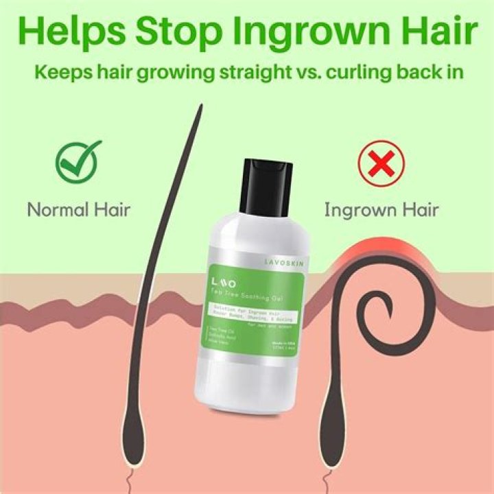 Best ingrown hair treatment - How To Discuss