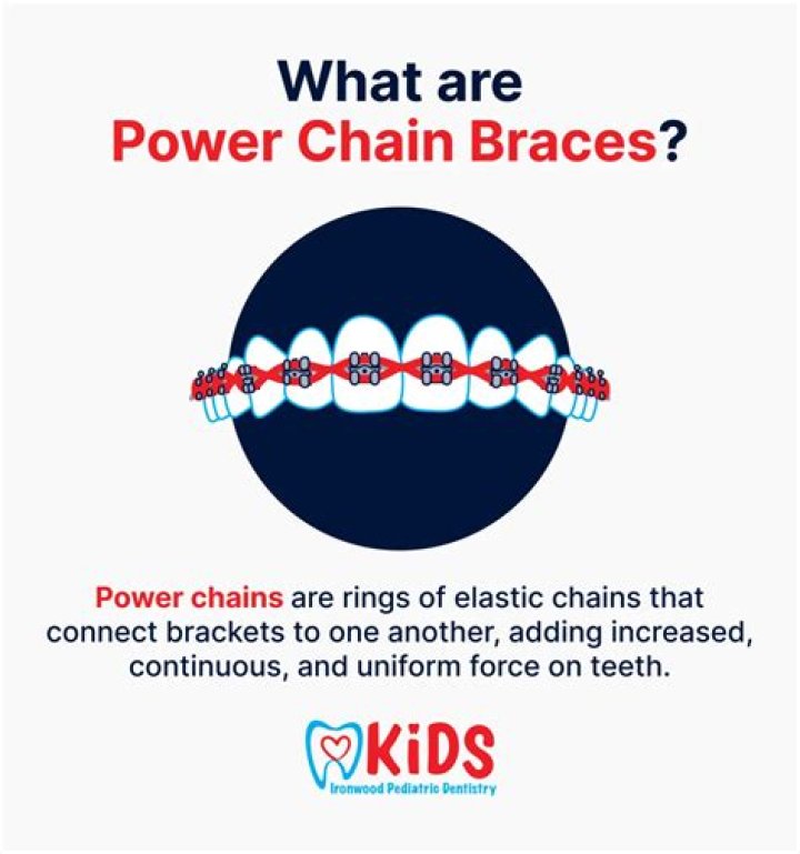 Braces Power Chain Broke - How To Discuss
