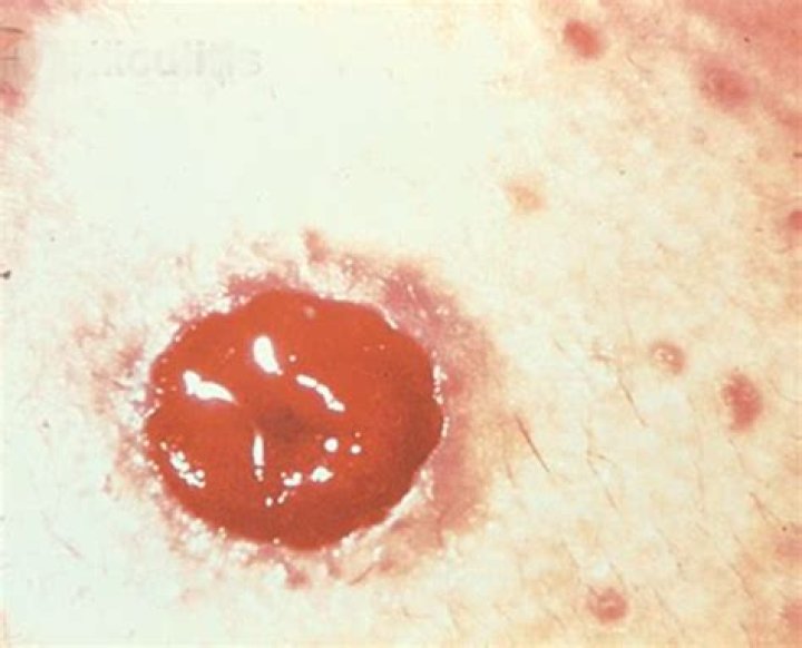 Can a stoma get infected