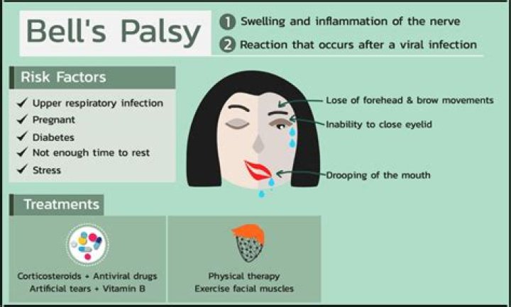 Can Bells palsy cause headaches