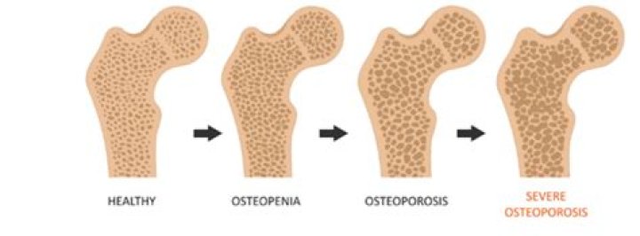 Does osteoporosis shorten life expectancy