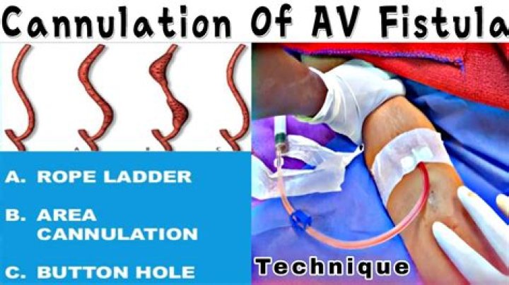 How do you AVF a Cannulate