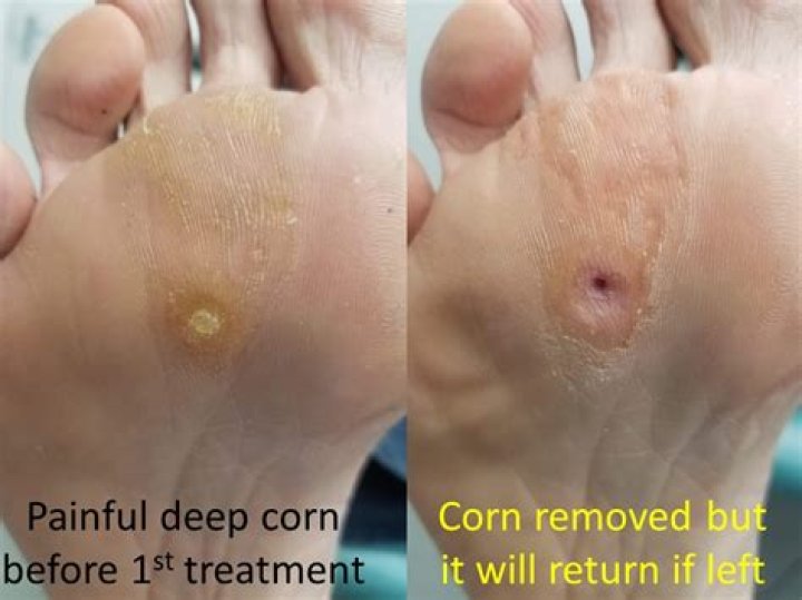 How do you treat skin after corn removal