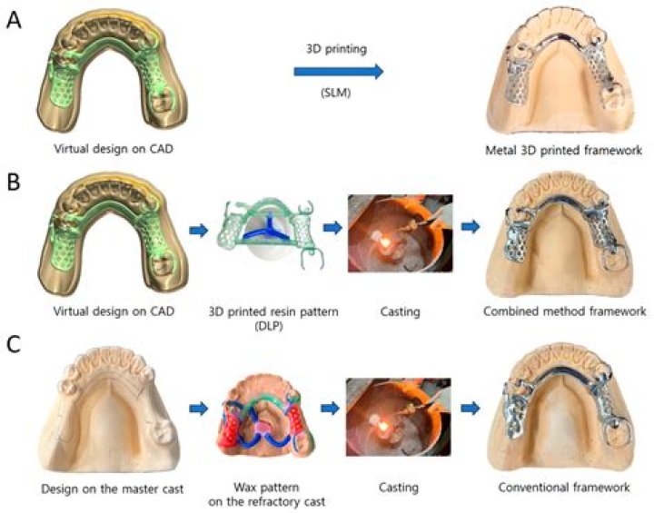 How is a removable partial denture casting done?