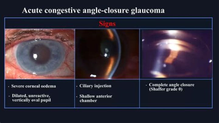 How is angle closure glaucoma treated