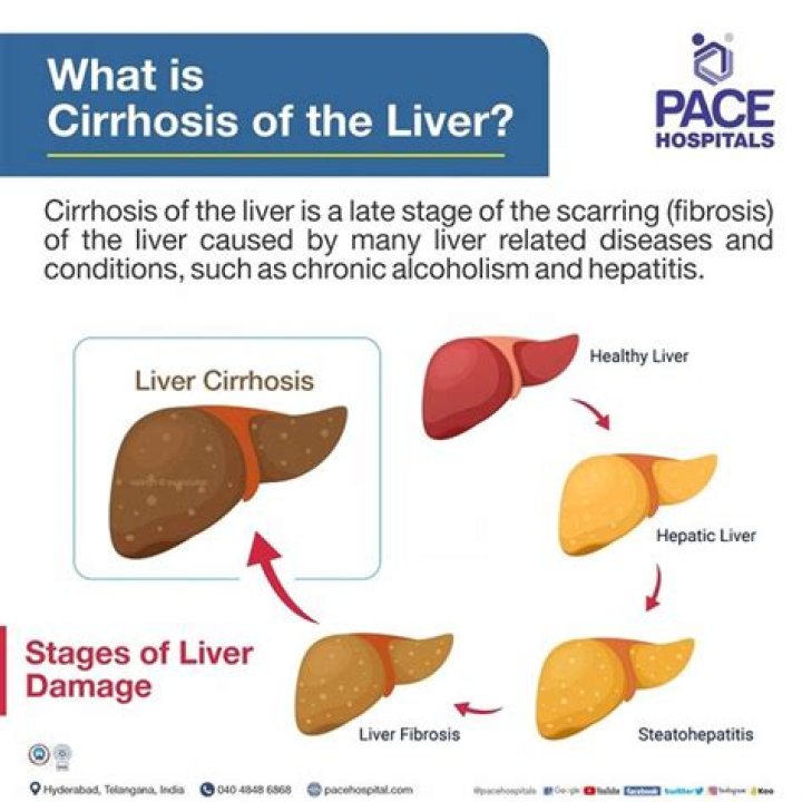 How long can you live with cirrhosis of the liver