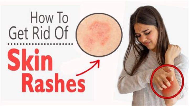 How To Get Rid Of A Band Aid Rash