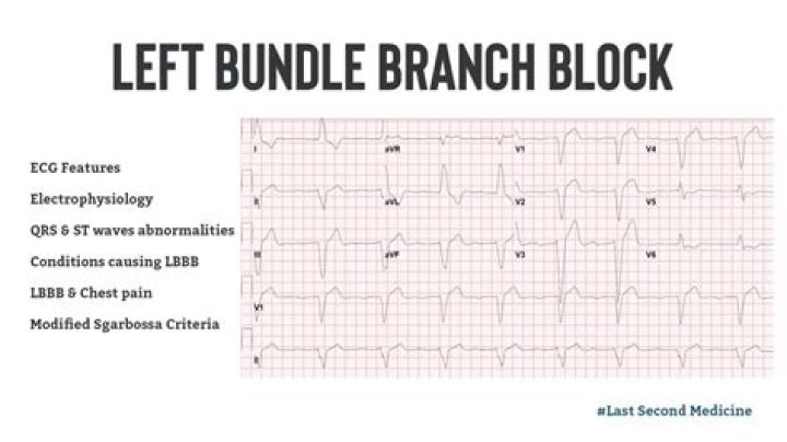 Is a left bundle branch block a serious condition