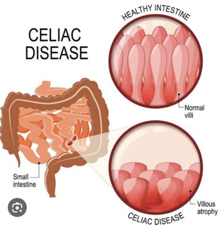 Is celiac sprue and celiac disease the same thing