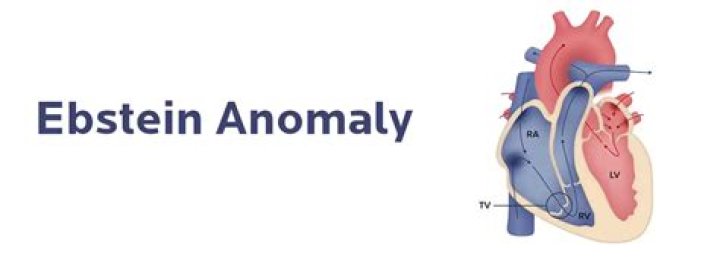 Is Ebsteins anomaly hereditary