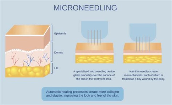 Is microneedling safe - How To Discuss