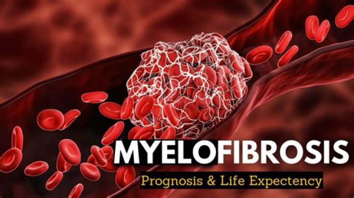Is myelofibrosis a terminal