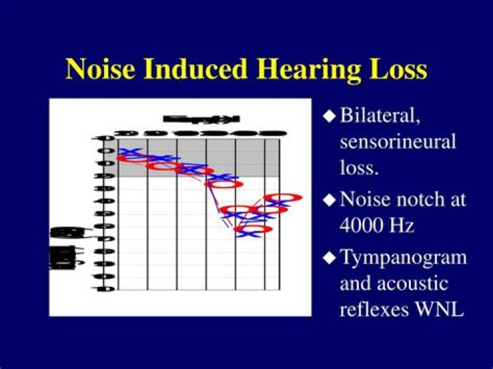 Is noise induced hearing loss conductive or sensorineural