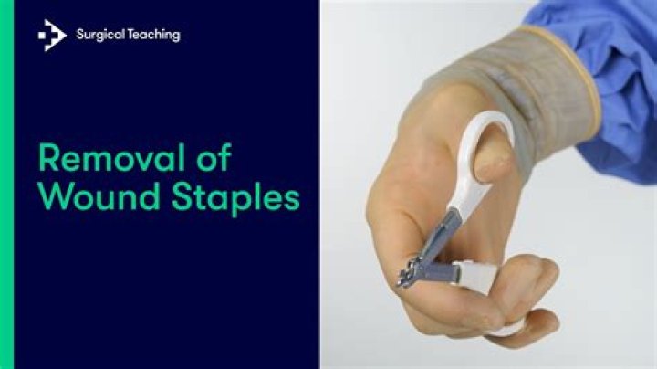 Surgical staple remover - How To Discuss