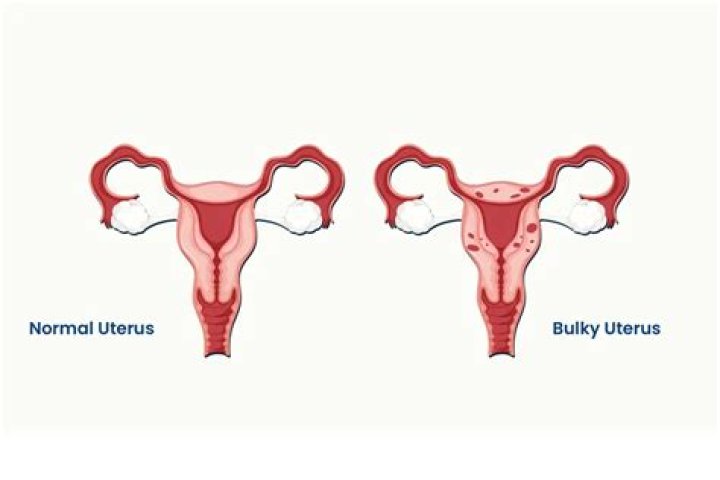 What does a boggy uterus mean