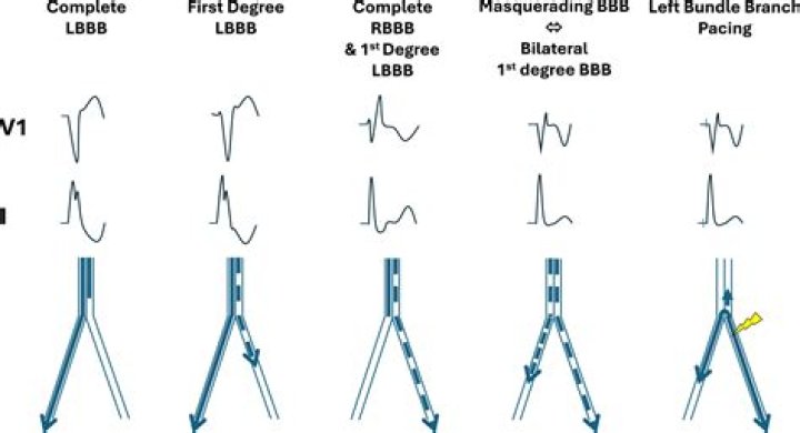 What does incomplete LBBB mean