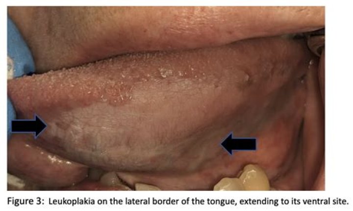 What does white lesion in mouth look like