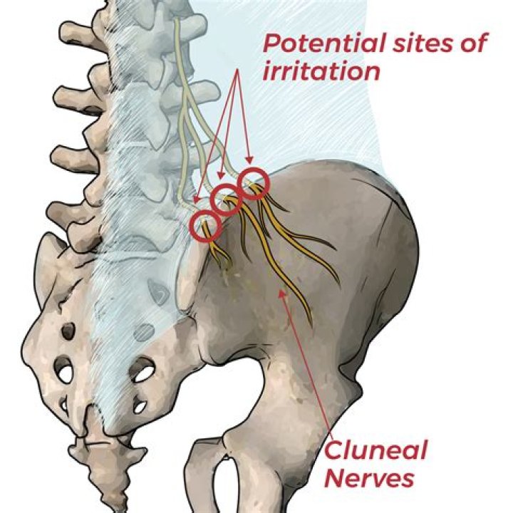 What is an Episacral Lipoma