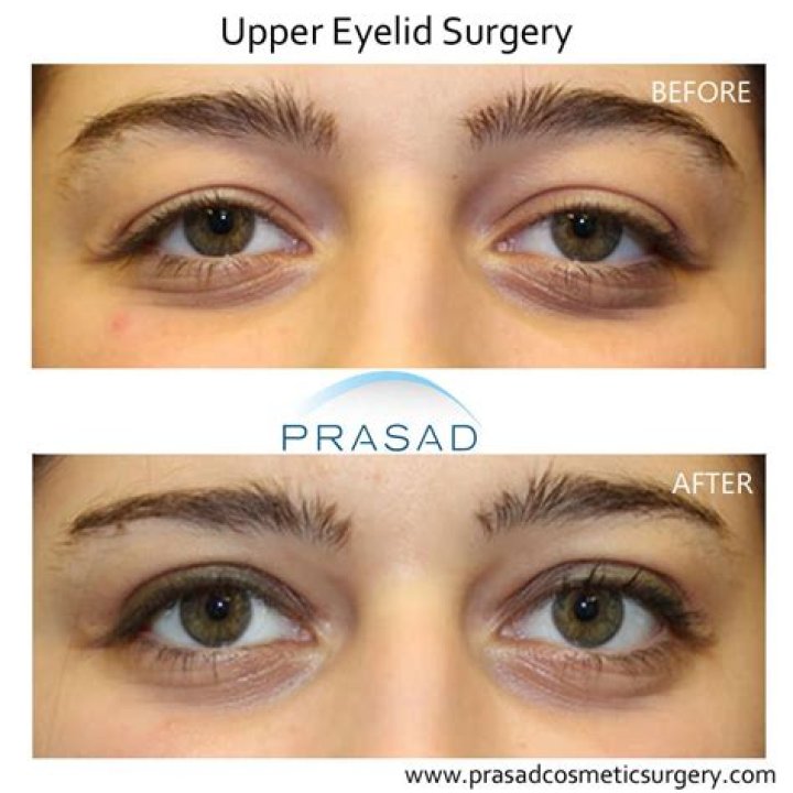 What is an inverted eyelid