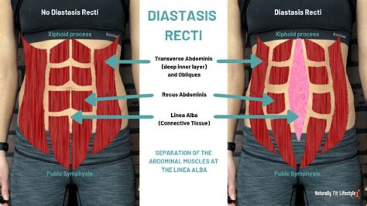 What is Diastasis of muscle