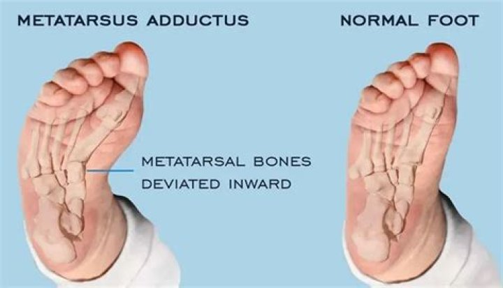 What is metatarsus varus