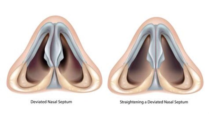 What is nasal debridement