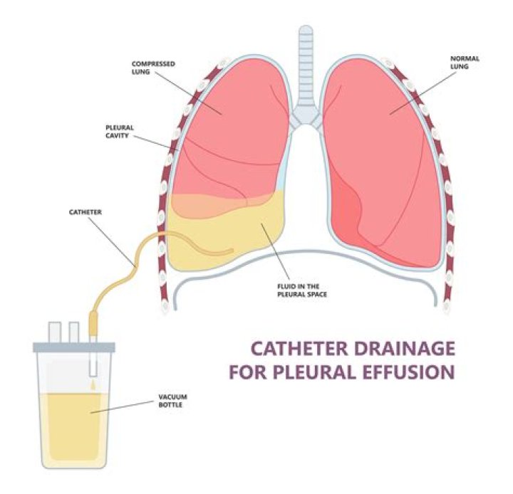 What is the CPT code for pleural effusion drainage