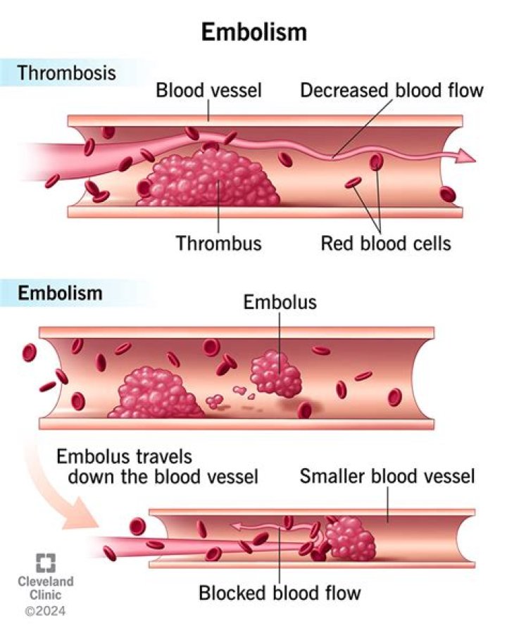 What is the difference between an embolus and an embolism