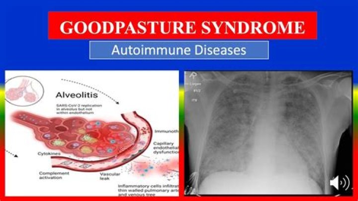 What is the survival rate of Goodpasture syndrome