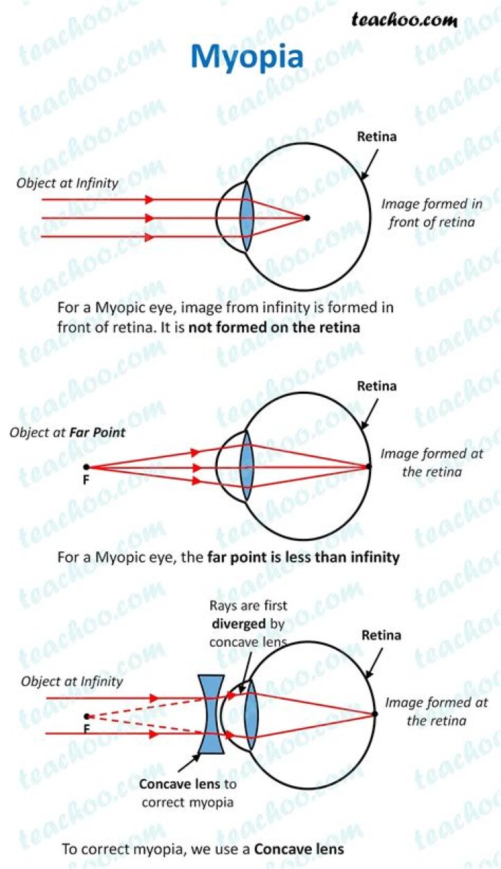 Which lens is used in myopia
