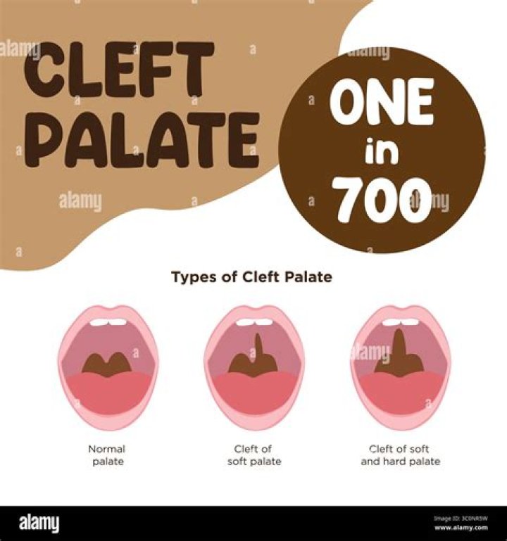 Which population has the highest prevalence for cleft lip and palate