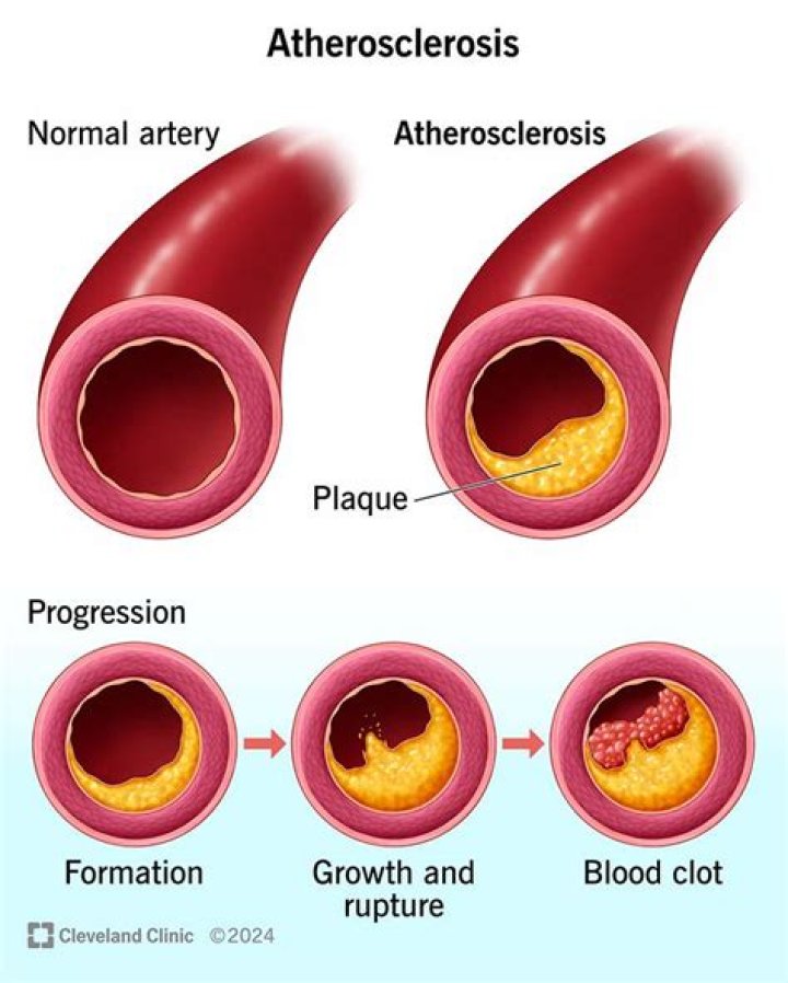 Who discovered arteriosclerosis