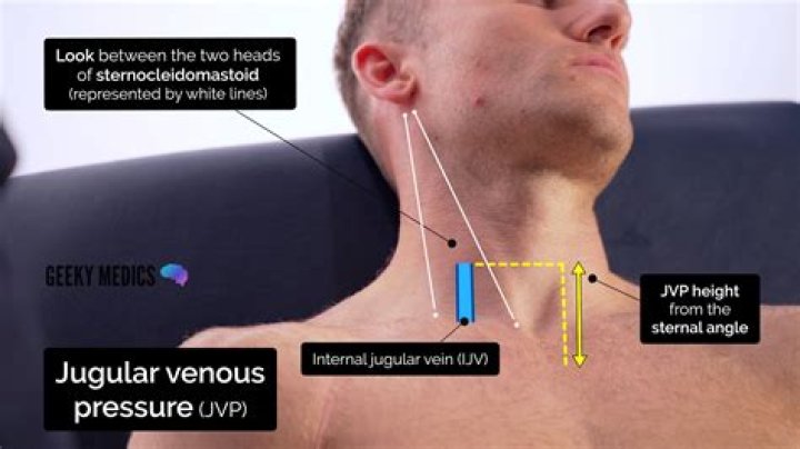Why do we measure jugular venous pressure